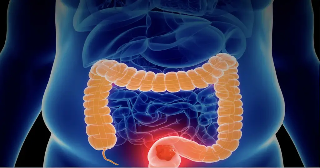 colon hydrotherapy treatment